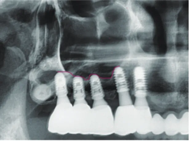 Fig. 5. Pre-operation X-ray.