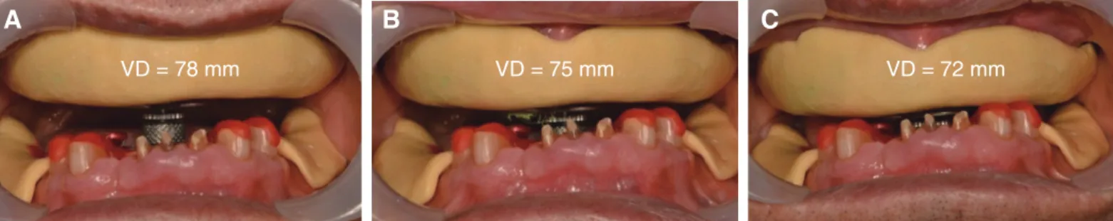 Fig. 3. Registration of centric relation using gothic arch tracer at three different VD (vertical dimension)