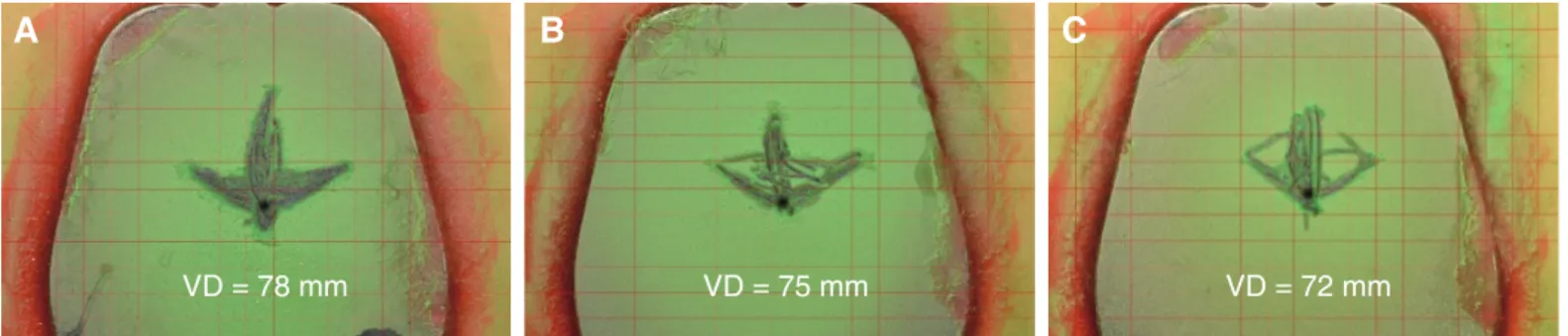 Fig. 4. Gothic arch tracing at three different VD (vertical dimension). (A) VD = 78 mm, (B) VD = 75 mm, (C) VD = 72 mm.