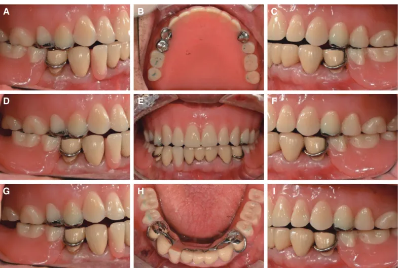 Fig. 9. Definitive denture placement and check the bite, (A) Working side (Right), (B) Maxillary denture, (C) Working side (Left), (D) Right side, (E) Frontal  view, (F) Left side, (G) Balancing side (Right), (H) Mandibular denture, (I) Balancing side (Lef