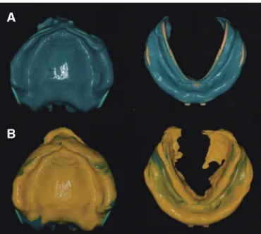 Fig. 1. Initial panoramic radiograph. Fig. 2. (A) Taking first impression, (B) Taking wash impression.