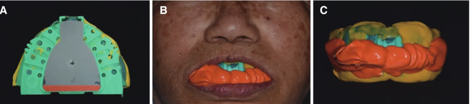 Fig. 6. (A) Gothic arch tracing with the EZ-tracer, (B) Bite registration, (C) Jaw relation record.