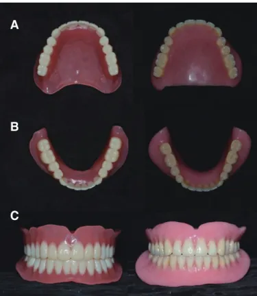 Fig. 11. Denture delivery. (A) Frontal view of DENTCA CAD/CAM denture, (B) Frontal view of Conventional denture.