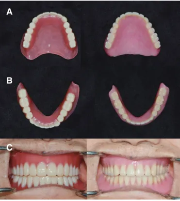 Fig. 13. (A) Occlusal view of maxillary complete dentures (Left: DENTCA  CAD/CAM denture, Right: Conventional denture), (B) Occlusal view of  mandibular complete dentures (Left: DENTCA CAD/CAM denture, Right: 