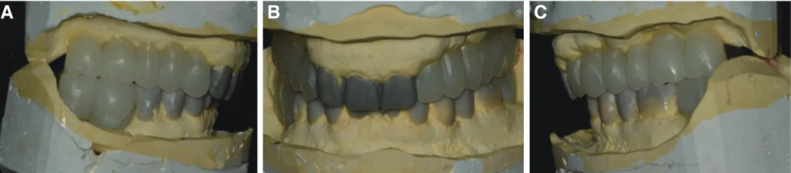 Fig. 3. Diagnostic wax up model with new occlusal vertical dimension. (A) Right lateral view, (B) Frontal view, (C) Left lateral view.