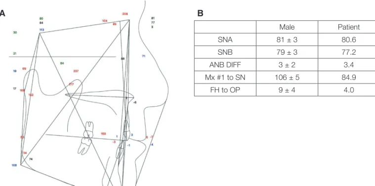 Fig. 5. Cephalometric analysis (A) Lateral Cephalography (B) Comparison of the cephalometric analysis on the patient and the male
