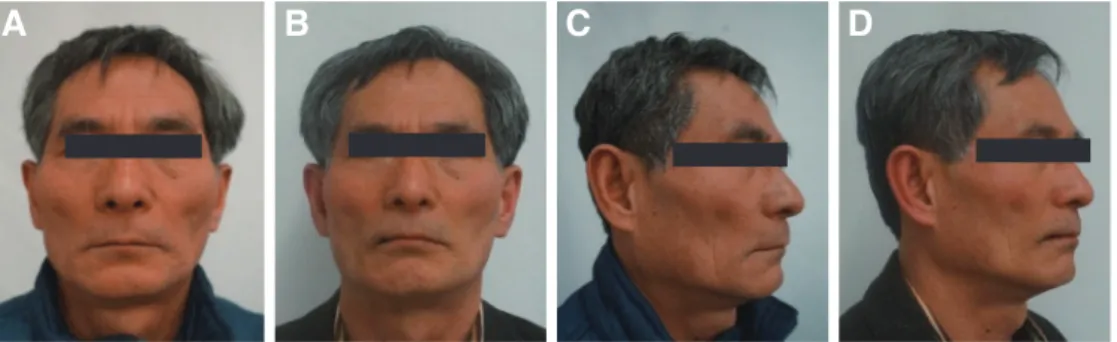 Fig. 8. Patient’s profile. (A) Frontal profile of first visit, (B) Frontal profile of after definitive denture delivery, (C) Lateral profile of first visit, (D) Lateral profile  of after definitive denture delivery.