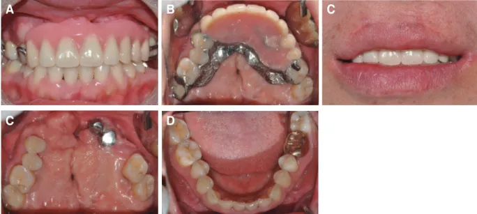 Fig. 10. Maxillary denture delivery. (A) Internal frontal view, (B) Mx. occlusal view indicate lingually positioned outer crown on #23, 24, (C) External frontal view, (D) Occlusal view without denture, (E) Mn