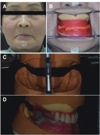 Fig. 3. Final impression and master cast fabrication. (A) Final impression of  maxilla, (B) Final impression of mandible, (C) Master cast of maxilla, (D)  Master cast of mandible.