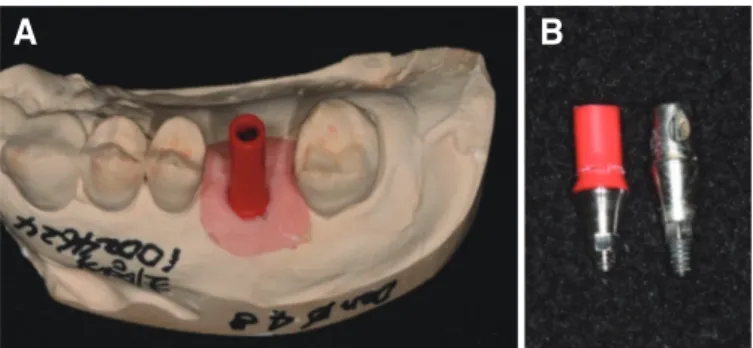Fig. 2. (A) Overextened burnout cylinder, (B) Burnout cylinder was trimmed  in accordance of fractured abutment.