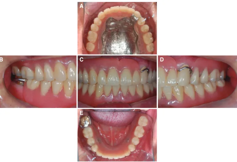 Fig. 4. Periapicalradiographs of #47. (A) First visit, (B) 3 year follow-up.