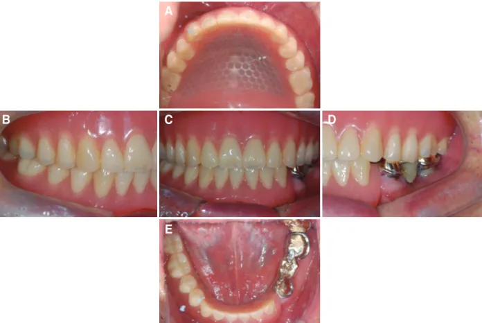 Fig. 8. Final prosthesis. (A) Upper, (B) Right, (C) Frontal, (D) Left, (E) Lower.