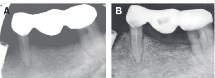Fig. 10. (A) Periapical radiographs of impression coping connection, (B)  Periapical radiographs of implants after 3 years of follow-up.