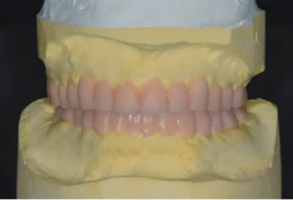 Fig. 6. Diagnostic wax-up with an increase of 3 mm of incisal  guide pin.