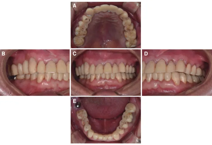 Fig. 7. Provisional restoration. (A) Upper, (B) Right, (C) Frontal, (D) Left, (E) Lower.