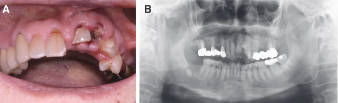 Fig. 1. (A) Initial intraoral photograph, (B) Initial panoramic radiograph. 