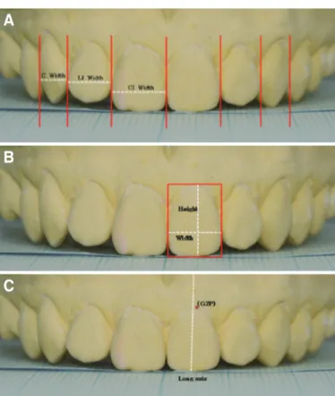 Fig. 1. Measurement for dental esthetic factors. (A) The measurement of vis- vis-ible mesiodistal width, (B) Apicocoronal height for maxillary central incisor,  (C) Determination of gingival zenith position (GZP) which is the highest  gingival marginal poi