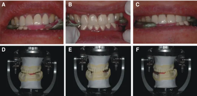 Fig. 4. Condylar guidance angle adjustment by check-bite method. (A, D) Right lateral movement, (B, E) Protrusive movement, (C, F) Left lateral movement.
