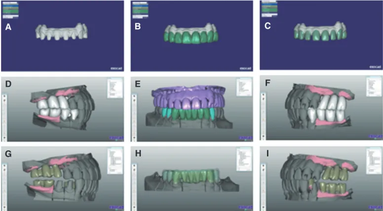 Fig. 5. Screw retained fixed interim restoration. (A) Frontal view, (B) Occlusal view.