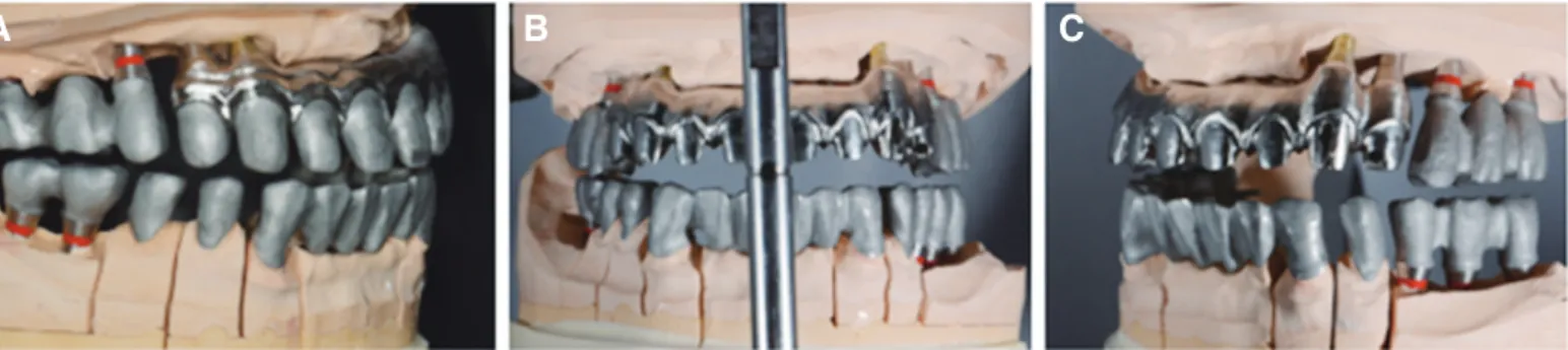 Fig. 7. Implant superstructure and coping fabricated with CAM. (A) Right view, (B) Frontal view, (C) Left view.