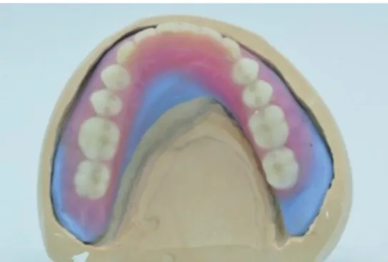 Fig. 6. Polished surface impression and CAD design. (A) Ledge at left lingual side for stability, (B) Wax denture scan file, (C) Master cast and wax denture de- de-sign interface.