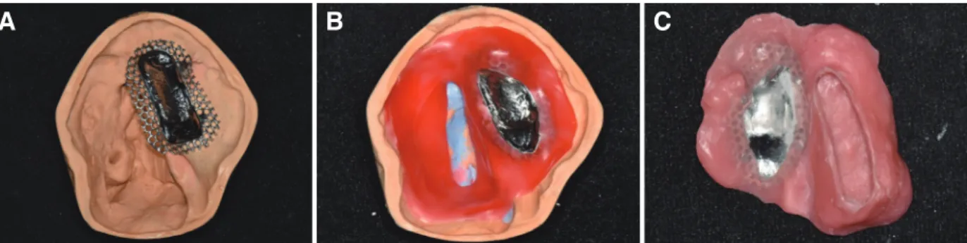 Fig. 5. (A) Metal framework, (B) 1.0 mm baseplate wax was applied for wall of bulb. Internal space was filled with silicone putty and record base was fabri- fabri-cated, (C) First base of obturator was cured.