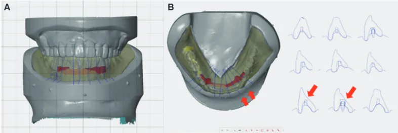Fig. 5. Esthetics and function were verified with interim prostheses. (A) Maxilla, (B) Right lateral, (C) Frontal, (D) Left lateral, (E) Mandible