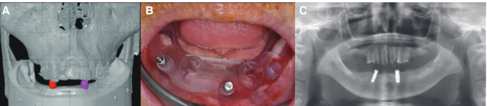 Fig. 10. (A) Face-bow transfer, (B) Mounting with mandibular temporary denture and maxillary occlusal rim to  make maxillary fixed prostheses.