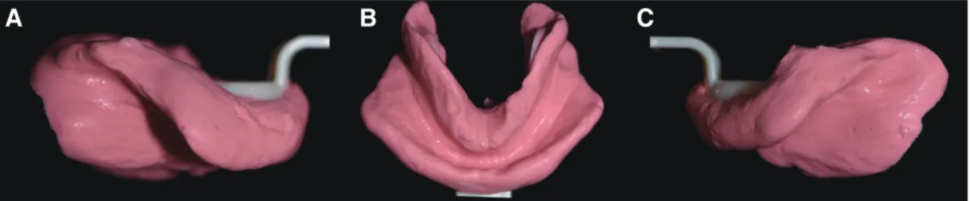 Fig. 3. Preliminary impression. (A) Right, (B) Middle, (C) Left.