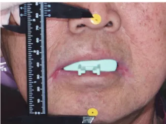 Fig. 4. Vertical dimensions were decided with centric tray. Fig. 5. Definitive dentures were cured with SR-Ivocap System.