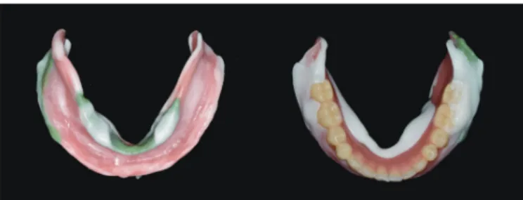 Fig. 9. Sublingual border of the final impression (A), wax denture (B), and final denture (C) in patient No