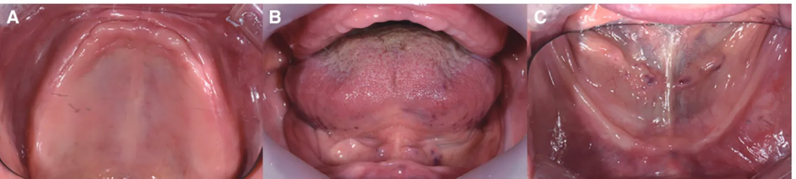 Fig. 12. BTC point gained after modifying the denture in patient No. 4. (A) Before, (B) After (R: right end, L: left end).
