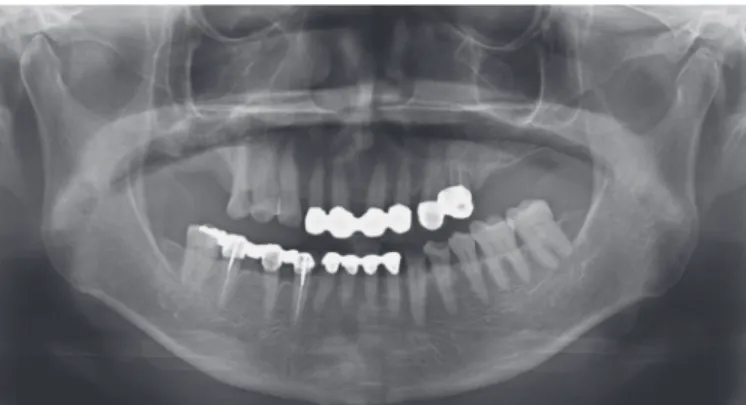 Fig. 2. Pre-treatment panoramic radiograph.