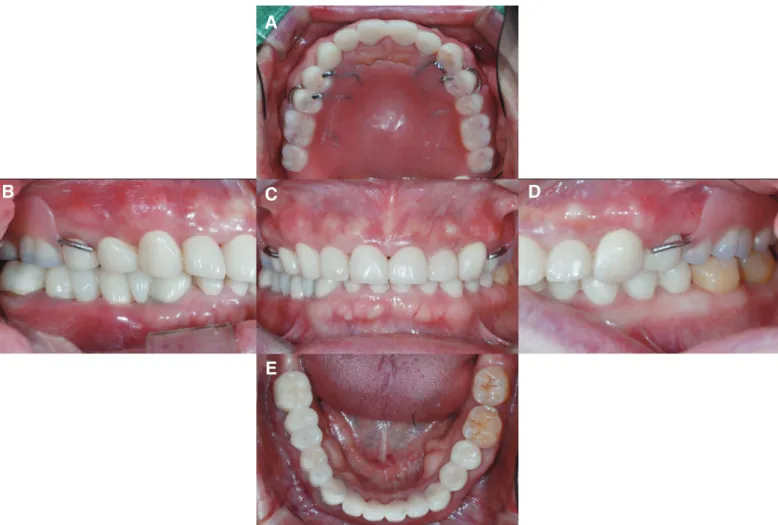 Fig. 8. Radiographic stent for implant placement. Fig. 9. Cone beam computed tomography images for implant placement in maxillary  edentulous area.