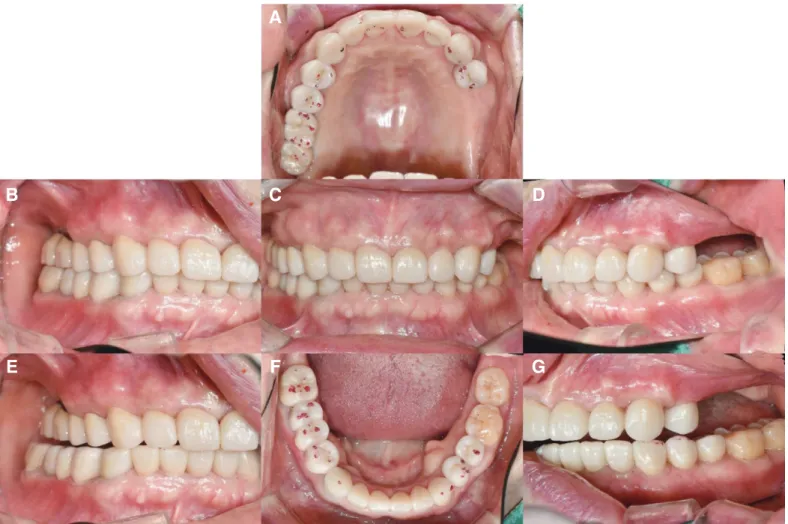 Fig. 16. Occlusal adjustment on definitive prosthesis. (A, B) Equal intensity  contact of all the teeth in centric occlusion, (C) Inner incline of lingual cusp  of #36 was adjusted to eliminate working side interference during  mandibu-lar movements in lef