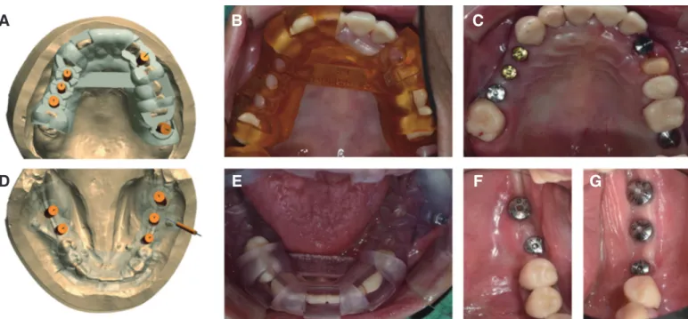 Fig. 3. Implant surgery with implant stent. (A, D) Implants were planned on maxilla and mandible, (B, E) Adaptation of surgical stent, (C, F, G) Implants were  installed and healing abutments were inserted.