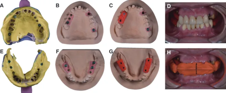 Fig. 4. Impression taking and recording of centric relation for provisional restoration