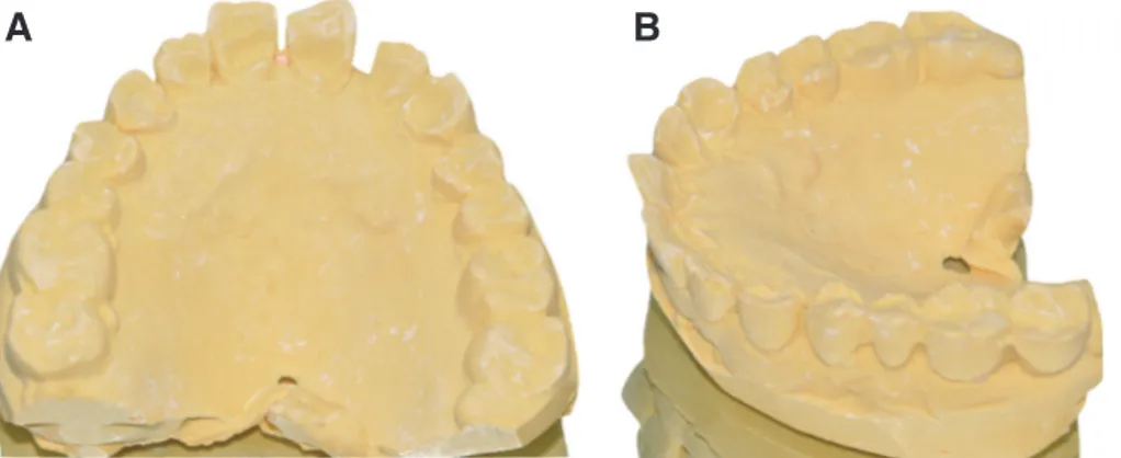 Fig. 3. Diagnostic cast of patient’s natural teeth showing (A) spacing and (B) attrition on the anterior teeth before anterior esthetic prosthodontic treatment