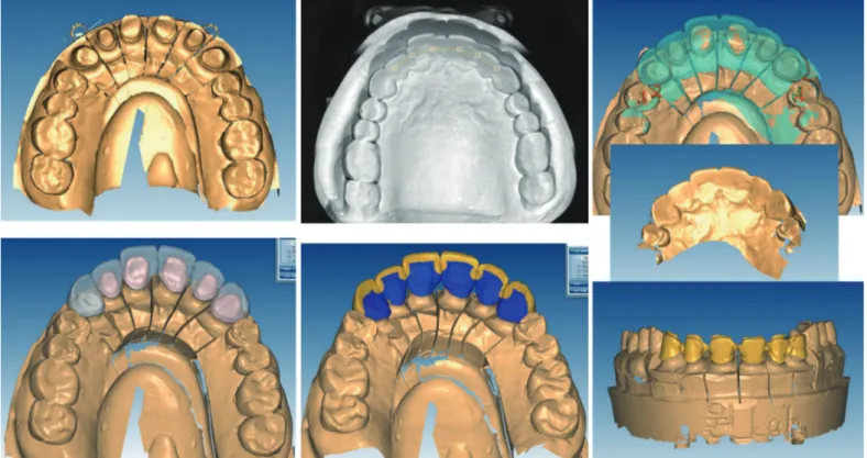Fig. 12. Digital duplication of the palatal contour of the provisional restoration.