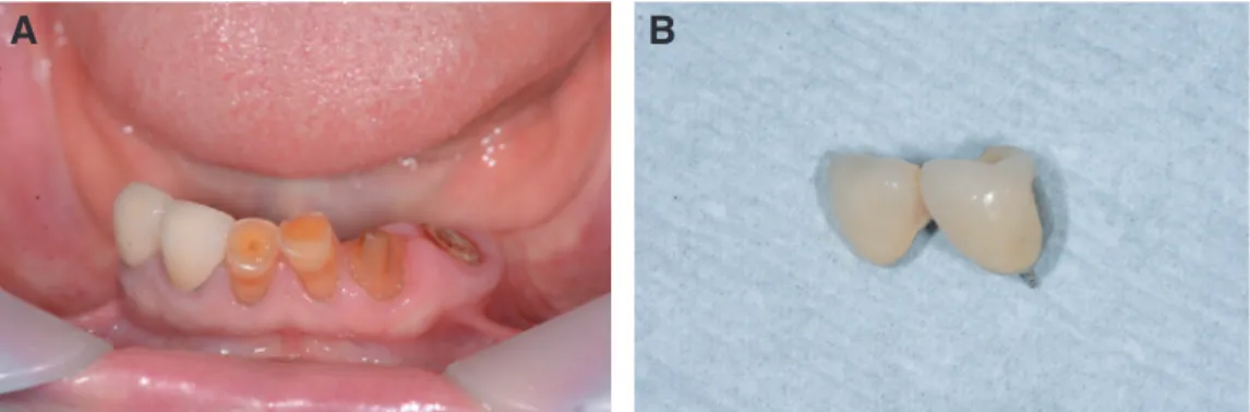 Fig. 1. Failure of metal ceramic crown with post and core for mandibular left canine and first premolar