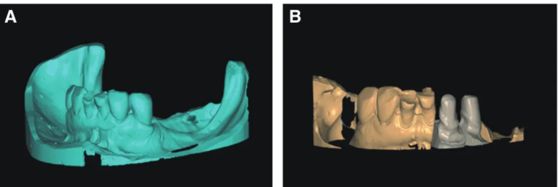 Fig. 4. (A) Scanned image of original model with dislodged prosthesis, (B) Scanned image of definitive cast of abut- abut-ment teeth.
