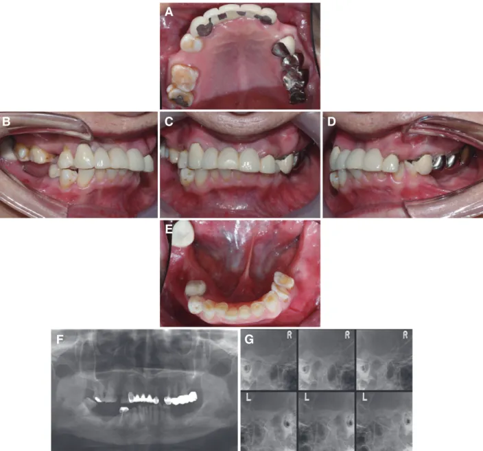 Fig. 1. Preoperative intraoral photographs and radiographic evaluation. (A) Maxillary occlusal view, (B) Right lateral view, (C) Frontal view, (D) Left lateral  view, (E) Mandibular occlusal view, (F) Panoramic radiograph, (G) Transcranial view are shown.