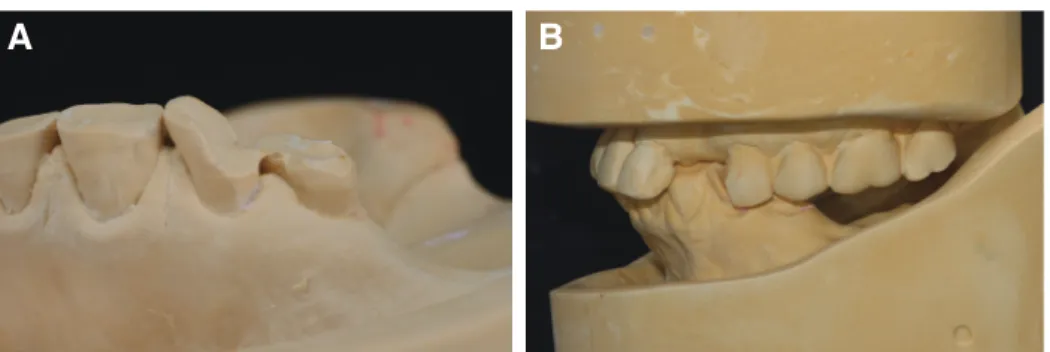 Fig. 3. Diagnostic cast analysis. (A) Excessive worn of mandibular left premolars, (B) Limited maxillo-mandibular space for restoration of left canine and pre- pre-molars are shown.