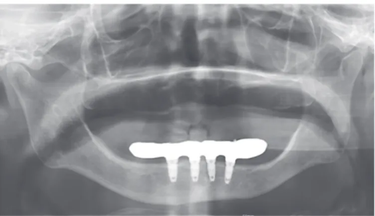 Fig. 10. Panoramic radiograph of definitive prosthesis.