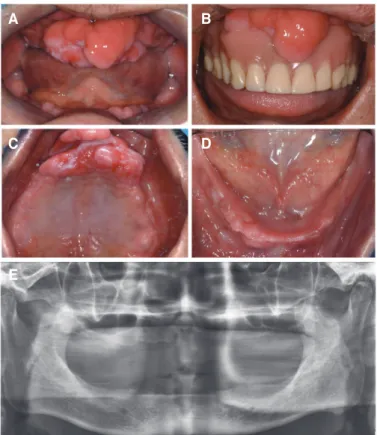 Fig. 2. Post-operative photographs. (A) the day after surgery, (B) displaced  flabby tissue, (C) maxillary old denture, (D) maxillary old denture with soft  liner.