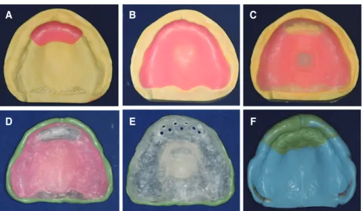 Fig. 4. (A, D) Master casts, (B, E) record bases and wax rims (C, F) additional mandibular record base with retentive wire and narrow pillars for neutral zone record.