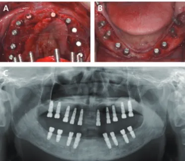 Fig. 5. CBCT images after sinus graft and alveolar bone augmentation.