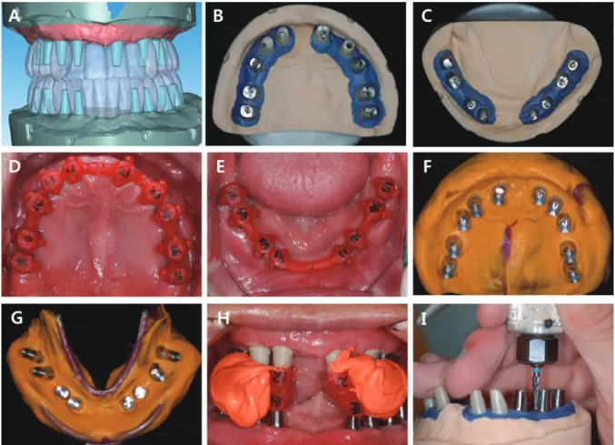 Fig. 7. (A) Computer aided design of individualized abutment, (B) Individualized zirconia and titanium abutments was connected to working model of maxilla, (C)  Individualized titanium abutments was connected to working model of mandible, (D) Bonnet crown 