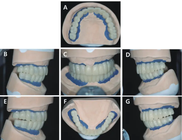 Fig. 8. Full contour wax-up for provisional restorations. (A) Maxillary occlusal view, (B) Right lateral view, (C) Frontal view (D) Left lateral view, (E) Lateral  movement - right side, (F) Mandibular occlusal view, (G) Lateral movement - left side.