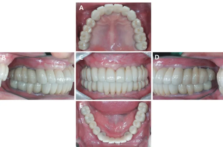 Fig. 12. Fabricating abutment replica with hot melt adhesive material. (A) Abutment replica of  maxillary anterior prosthesis, (B) Abutment replica of mandibular anterior prosthesis.